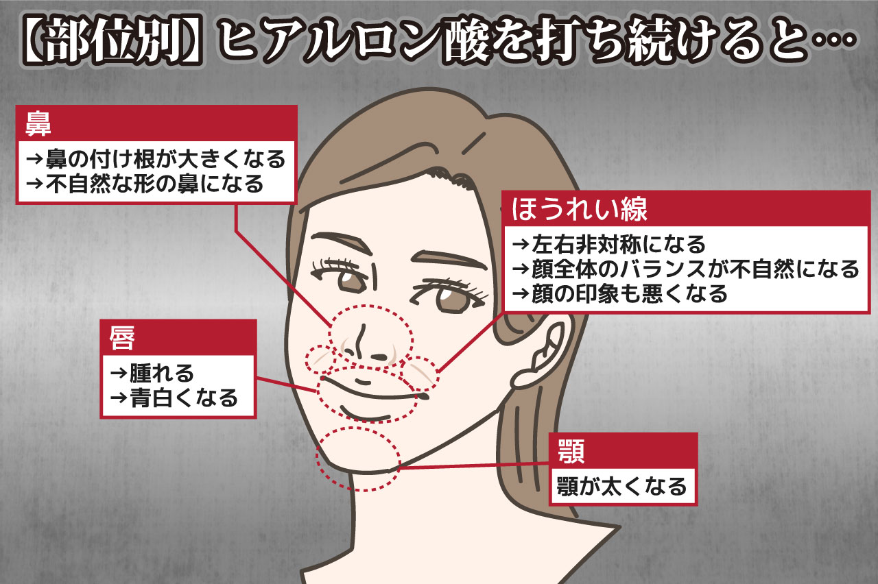 ヒアルロン酸を打ち続けるとどうなる？注意点を解説！